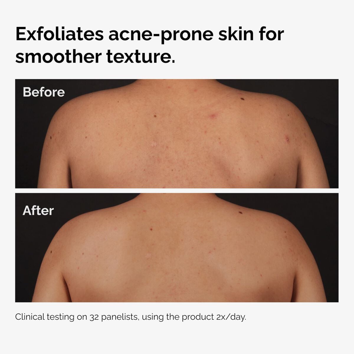 salicylic-acid-0-5-body-serum-c5 ord-salicylic-acid-body-serum-before-after-graphic-NA.jpg