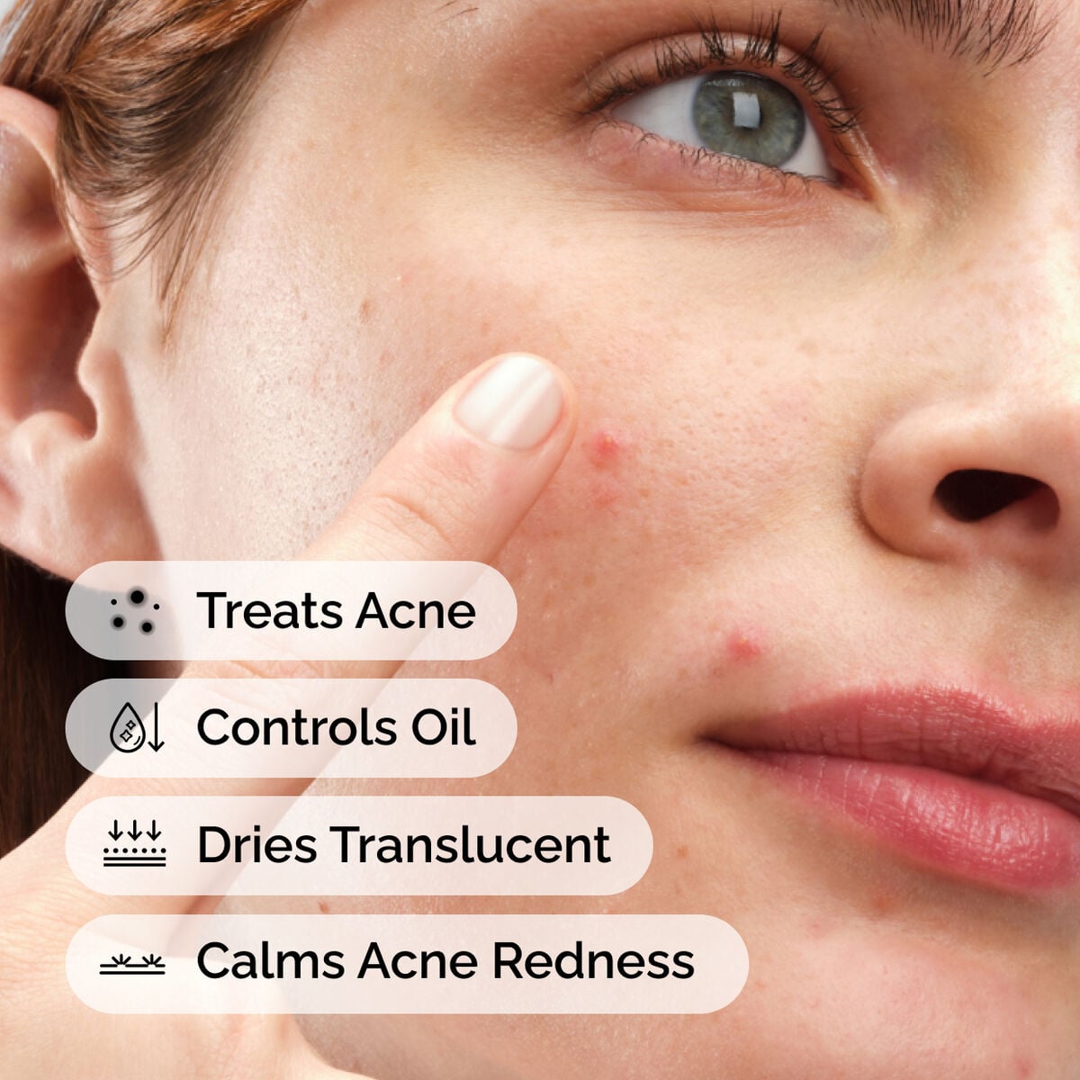 sulfur-10-powder-to-cream-concentrate-c2 ord-sulfur-10pct-powder-to-cream-concentrate-model-application-with-benefits-acne.jpg